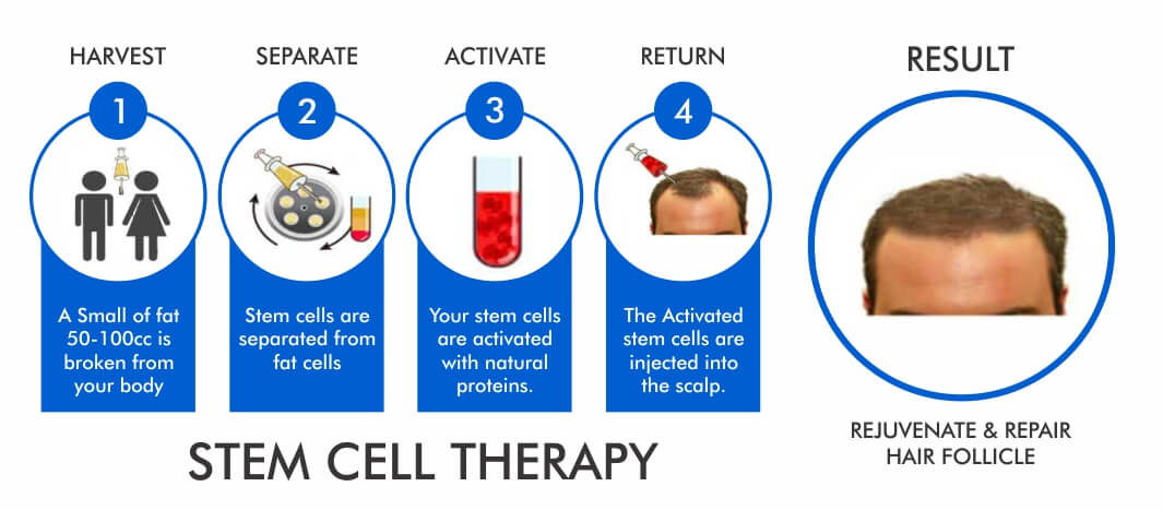 Regain Hair Clinic Stem Cell Therapy Regain Hair Clinic Stem Cell Therapy